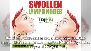 10 Home Remedies To Treat Swollen Lymph Nodes Naturally Youtube