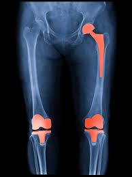 Hip pain affects your overall quality of life normal, everyday activities like walking, standing, sitting, bending over, and climbing stairs cause pain or become difficult you experience hip or groin pain even when resting or when the joint is not in use How Long Will My Hip Or Knee Replacement Last Harvard Health