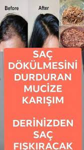 Sac Dokulmesini Durdurun Sac Dokulme Tedavileri Sac Dokulmesi Sac