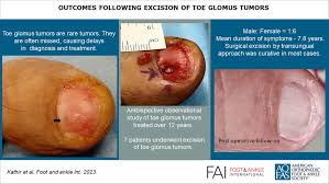 Image result for Glomus tumor