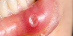 Por Que Se Me Hincha El Labio Superior De Repente Todas Las Causas