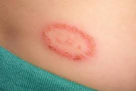 Best Ways To Recognize And Treat Ringworm Infection Ringworm can affect skin on almost any part of the body as well as fingernails and toenails. treat ringworm infection