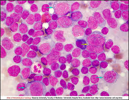 Aitl is generally a rapidly progressive disease. Angioimmunoblastic T Cell Lymphoma Cell Atlas Of Haematological Cytology