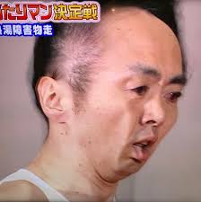 芸能人 はげ 写真