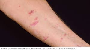 Slide Show Common Skin Rashes Mayo Clinic