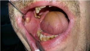 The injury can be in the form of. An Unusual Parotid Sialolith Diagnosis And Treatment A Case Report