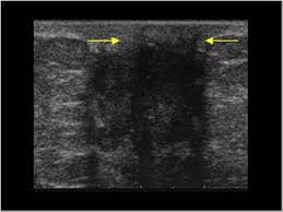 Teh w, wilson ar (1998) the role of ultrasound in breast cancer screening. Breast And Axilla 5 8 Male Breast Case 5 8 2 Malignant Breast Tumors In Male Patients Ultrasound Cases