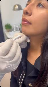 Tratamiento realizado: RINOMODELACION Y MENTOPLASTIA, ambos procedimientos  se realizan con aplicación de ácido hialuronico y el resultado es  INSTANTÁNEO. , Te dejamos el ANTES y DESPUÉS de nuestra ...