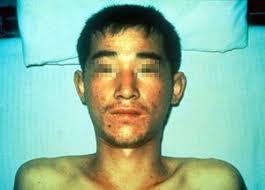 Dengue fever)‏ أو حمى تكسير العظام (بالإنجليزية: Ø§Ù„Ø­Ù…Ù‰ Ø§Ù„Ù†Ø²ÙÙŠØ© Ø§Ù„ÙÙŠØ±ÙˆØ³ÙŠØ© Ù…ÙˆØ³ÙˆØ¹Ø© Ø§Ù„Ø¹Ù„ÙˆÙ… Ø§Ù„Ø¹Ø±Ø¨ÙŠØ©