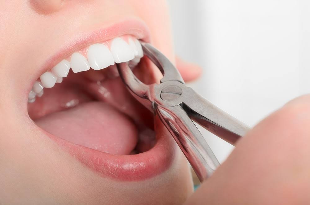 Tooth Extraction (Simple / Surgical) product image