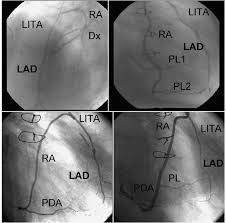 No diagonal branches were visualized in just seven cases (1.3%). Postoperative Angiography Of A Radial Arterial Ra Y Composite Graft Download Scientific Diagram