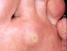 Image result for Corns