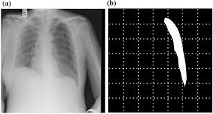 Check spelling or type a new query. Detection Of The Location Of Pneumothorax In Chest X Rays Using Small Artificial Neural Networks And A Simple Training Process Scientific Reports
