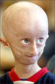 Image result for progeria case in bihar