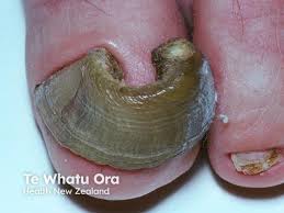 Image result for Onychogryphosis feet