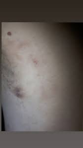 Try soothing your armpit skin by applying some aloe vera or some gentle moisturizer to the affected area. Lump Help Please Cancer Forums Patient