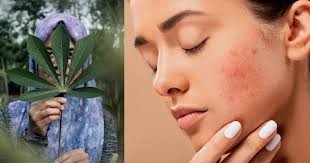 Cara menghilangkan bekas luka baik itu di bagian tangan, wajah, kaki, atau kulit yang lainnya ini sangatlah mudah, asal kamu bisa teratur dan telaten mengobatinya. Tampil Lebih Menawan Ini Cara Ringkas Menghilangkan Parut Luka Jerawat Hijabista