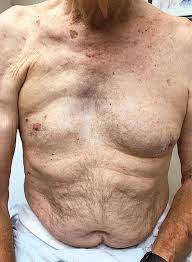 Taufiq Khan On Twitter Poland Syndrome Unilateral Absence Of Pectoralis Major Muscle The Formula 1 Driver Fernando Alonso Has This Condition