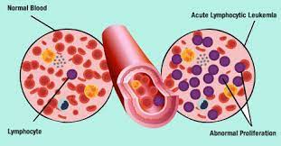 They recognize risk factors—smoking, diabetes. Blood Cancer Types And Stages Indus Health Plus