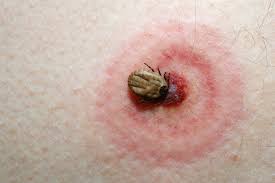 For minor black widow spider bites, home care treatments are limited. Diagnosing And Treating Insect Bites And Stings On The Lower Extremity Podiatry Today