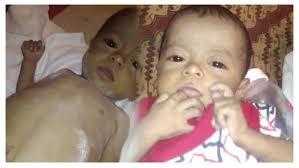 Adek Grace Terkena Virus CMV di Usia 9 Bulan