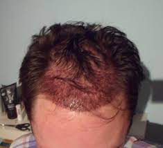 Kopfhautpigmentierung) tricopigmentation, prp und andere behandlungen als ergänzung / alternative. Haartransplantation Forum Arzte Und Kliniken Vor Dem Eingriff Warum Hat Moser Medical Hier So Einen Ungerechtfertigten Schlechten Ruf