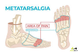 Metatarsal pain usually comes on gradually with tenderness felt when pressing in on the mtp joints under the ball of the foot. Ball Of Foot Pain Do The Bottoms Of Your Feet Toes Hurt