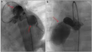 About 25% of all patients with dilated cardiomyopathy have atypical chest pain. Frontiers Covid 19 State Of The Adult And Pediatric Heart From Myocardial Injury To Cardiac Effect Of Potential Therapeutic Intervention Cardiovascular Medicine