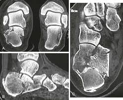 Image result for Calcaneus Compression Fracture