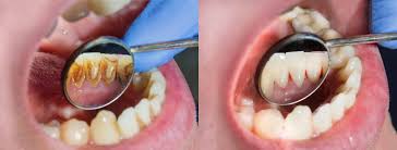 See all parts of this guide hide guide parts. When Does Plaque Become Dangerous Wollongong Dentist 4 U