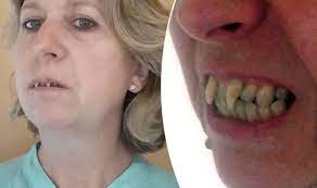 Dentist Ignored Woman S Gum Disease With Dire Consequences Express Co Uk