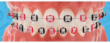 It's where your interests connect you cute braces colors cute girls with braces baddie hairstyles black girls hairstyles straight hairstyles braces tips braces bands teeth braces gold. Braces Orthodontist Bozeman Mt Braces Invisalign Rector Orthodontics