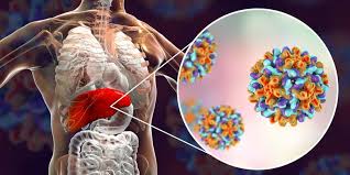 Hepatitis yang berlangsung kurang dari 6 bulan disebut hepatitis akut. Apakah Penyakit Hepatitis Menular Halaman All Kompas Com