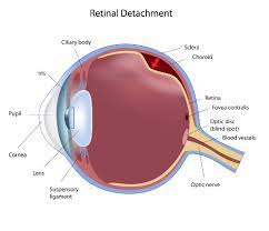 Retinal detachment occurs when the retina becomes separated from the pigmented cell layer that nourishes it. Don T Mess Around With Retinal Tears Better Vision Guide