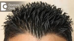 If hair loss is associated with an excess of testosterone in the body, the endocrinologist prescribes corrective therapy. How To Treat Androgenic Alopecia Not Responding To Minoxidil Finasteride Dr Aruna Prasad Youtube