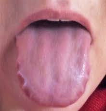 Maybe you would like to learn more about one of these? Causes Of Teeth Marks On Tongue Teethwalls