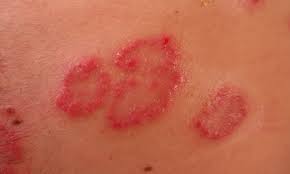 Image result for pruritic urticarial papules and plaques of pregnancy