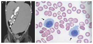 Image result for Splenomegaly