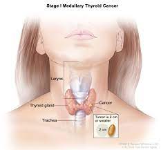 Follicular thyroid cancer makes up about 10% to 15% of all thyroid cancers in the united states. Thyroid Cancer Treatment Adult Pdq Patient Version National Cancer Institute