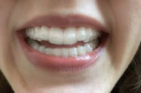 We are invisalign platinum elite providers in birmingham, giving you the confidence to relax knowing that you are in good hands. 11 Things I Wish I D Known Before I Got Invisalign Health Com