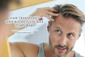 Shock loss caused by trauma of a hair transplant, causing native hairs to temporarily shed. Shock Hair Loss After A Hair Transplant Ways To Prevent Hair Transplant Shock Loss