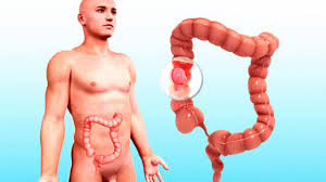 Hos mennesker er tykktarmen ca. Kreft I Tykktarm Og Endetarm Lommelegen