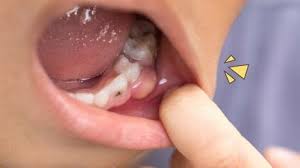 Sakit gigi berlaku apabila rasa ngilu pada gigi diakibatkan oleh karies gigi, rahang, gingivitis dan banyak lagi. 5 Penyebab Dan Cara Mengatasi Gusi Bengkak Pada Anak Jangan Panik Dulu Orami