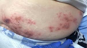 Image result for zoster under breasts