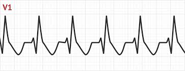 In such cases, other ekg. Svt With Aberrancy Tachyarrhythmias Medschool