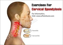 Exercises For Cervical Spondylosis Cervical Spondylosis Cervical Exercise