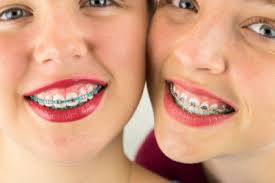 Majorly the braces colors for girls include the following: Orthodontics Blog Baton Rouge Fruge Orthodontics