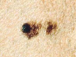 Some types of skin cancer are more dangerous than others, but if you have a spot. Common Moles Dysplastic Nevi And Risk Of Melanoma National Cancer Institute