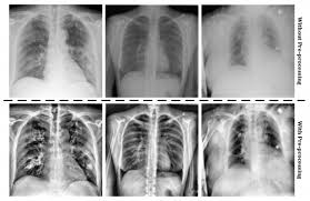 Using Lung X Rays To Diagnose Covid 19 Imaging Technology News