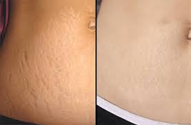 Pulsed dye laser treatment — for pink and red stretch marks, we use pulsed dye lasers. Meso Stretch Mark Remover Best Stretch Marks Treatment